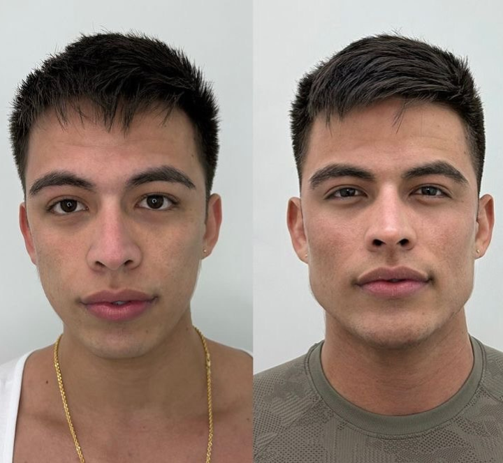 Refined Definition . Without Clinics, Without Effort